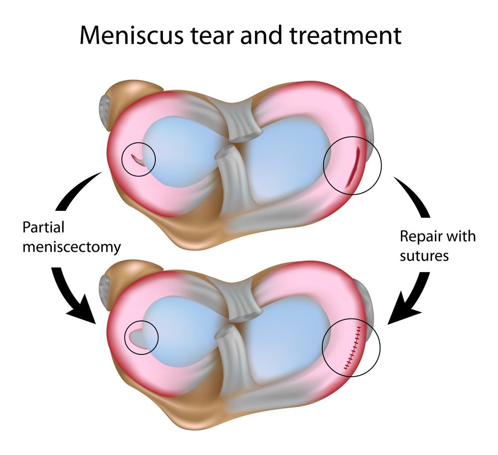 Diferencia entre meniscectomía y sutura meniscal